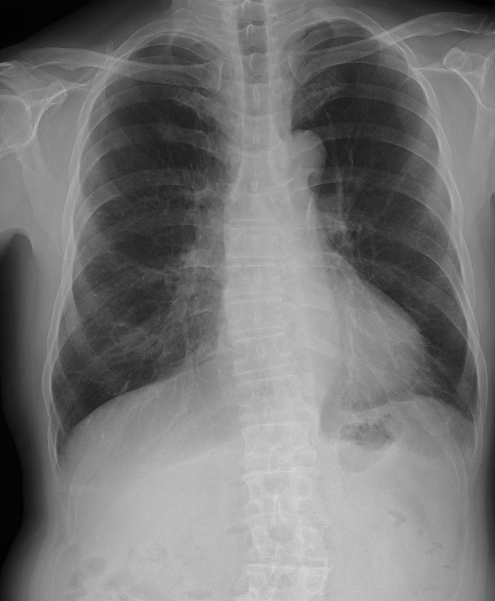 AI画像解析前胸部X線写真(demonstration用画像使用)