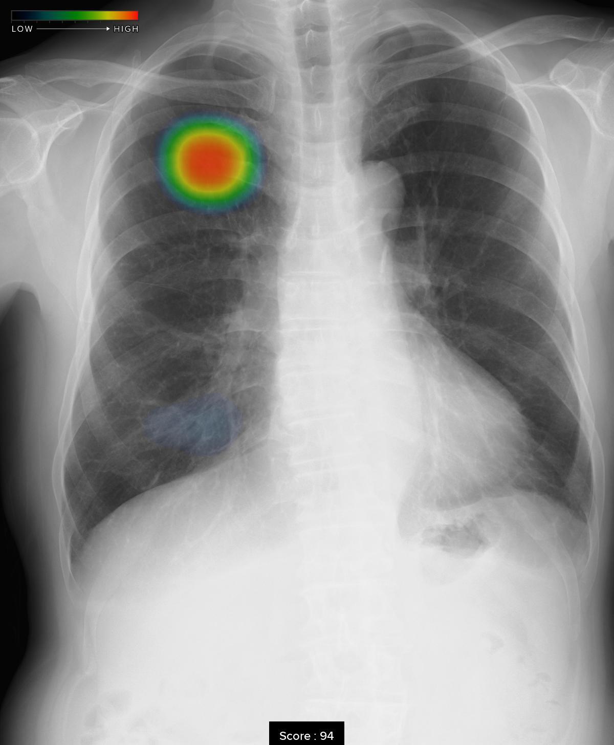 AI画像解析後胸部X線写真（demonstration用画像使用）:胸部X線での所見の見落としをできる限り減少させるために2023年4月より導入しました。